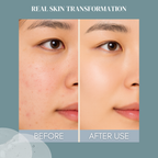 CONSLY Post Acne Toner Essence - Snail Mucin & Niacinamide | 6,76 fl.oz